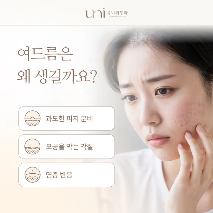 여드름 발생 원인 — 피지 과다 분비와 모공 막힘 과정